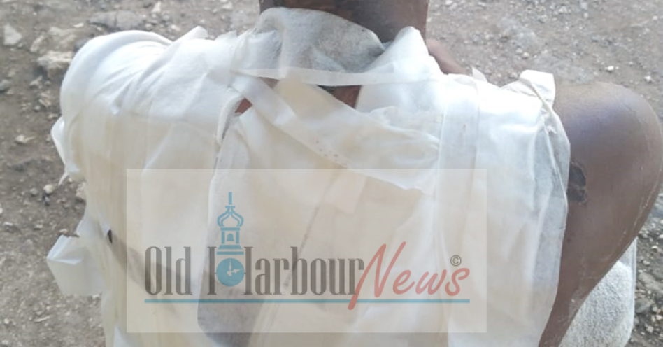 The 15-year-old boy suffered severe burns to his entire back and parts of his ears.